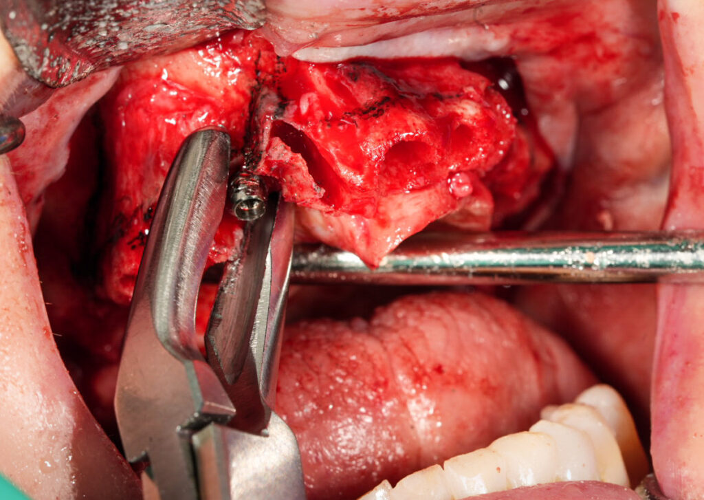 Removing an integrated implant during full-arch surgery