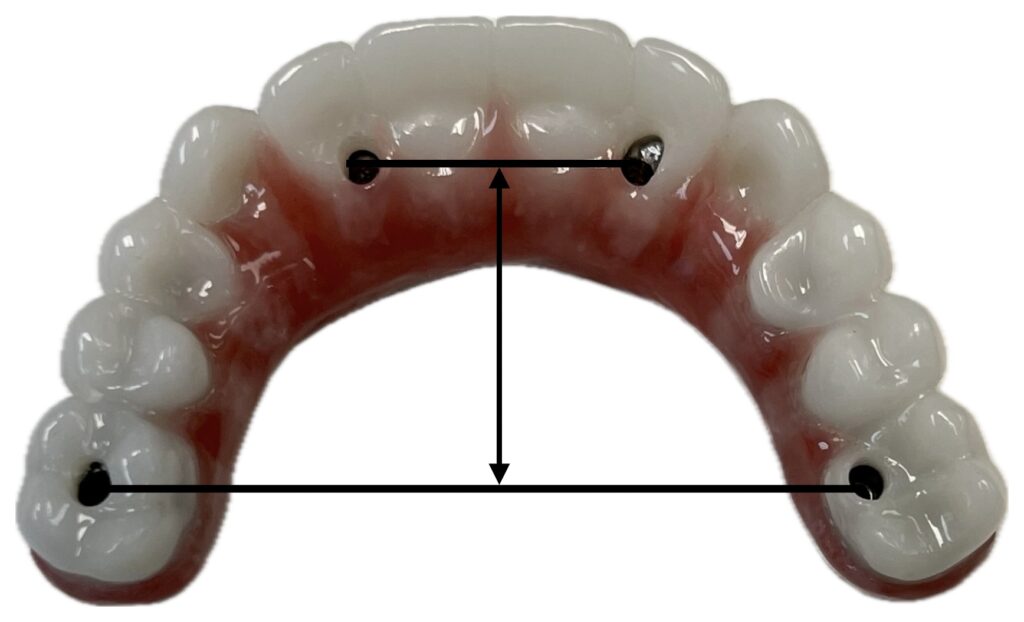 AP spread, the distance between the anterior and posterior implants