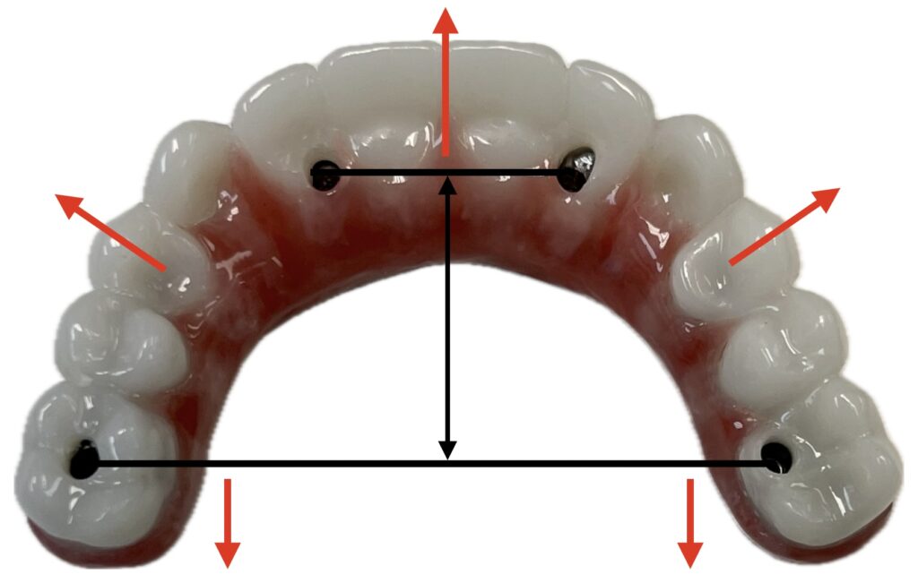 Cantilever forces acting outside the implant footprint