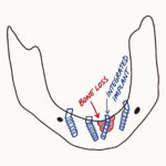 Hand drawn mandible showing four full-arch implants with bone loss around one integrated implant
