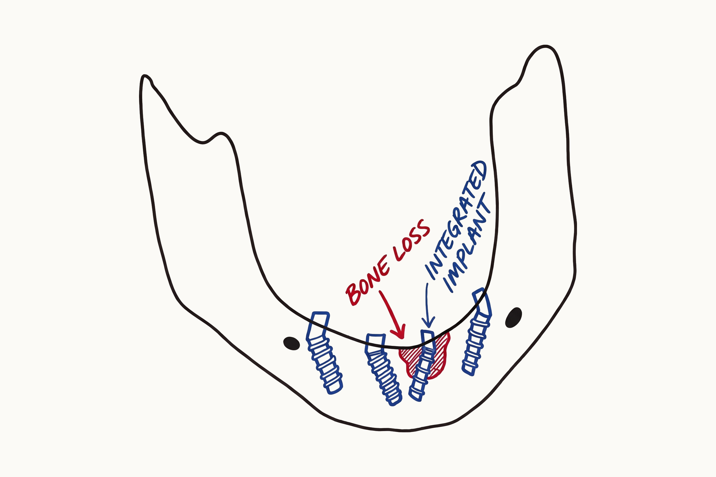 Hand drawn mandible showing four full-arch implants with bone loss around one integrated implant