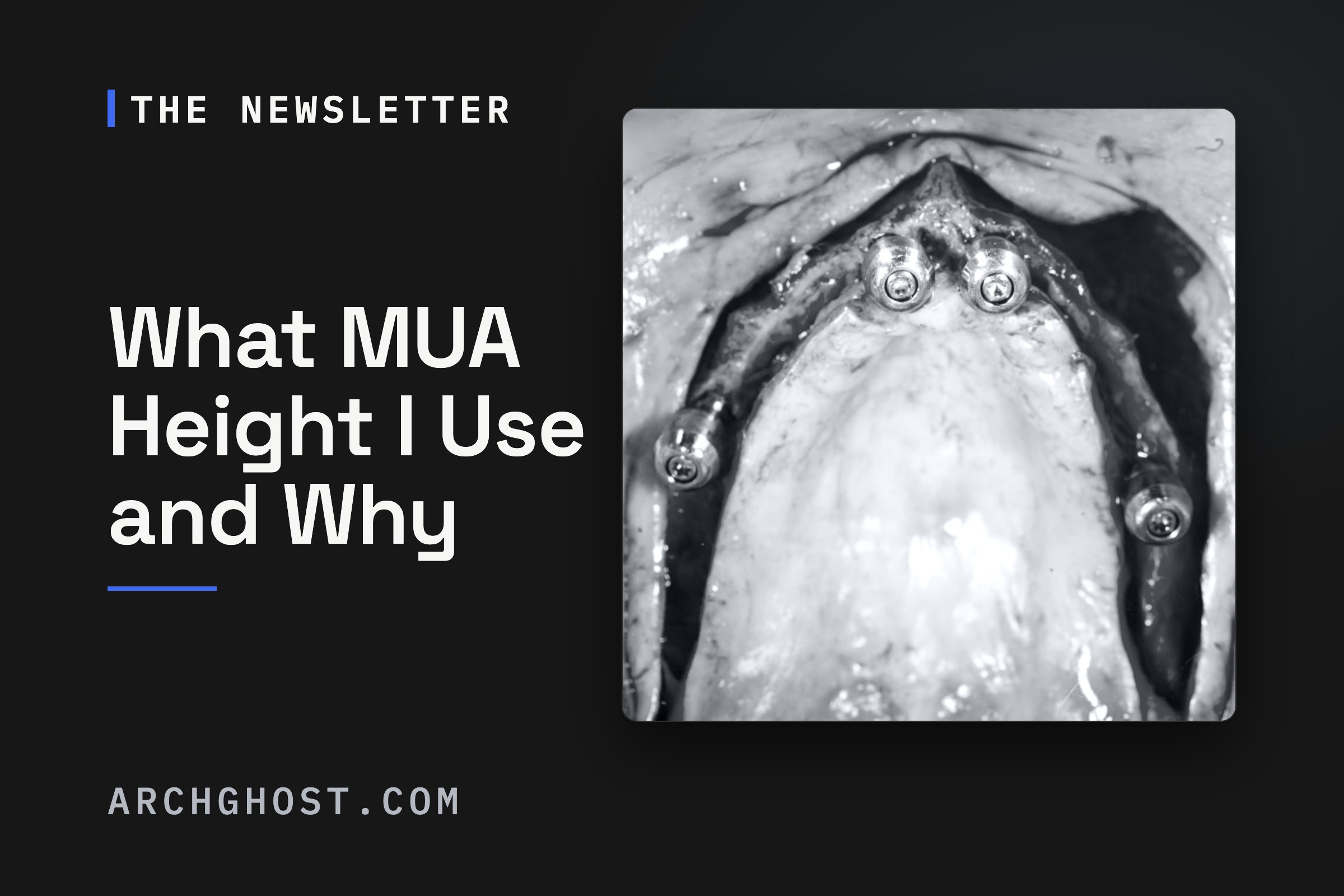 What MUA Height I Use and Why, The Arch Ghost Newsletter. Occlusal mirror view of a maxillary full-arch case with four multi-unit abutments seated.